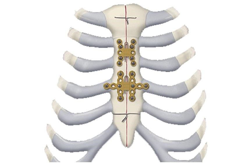 Matrix Thorax